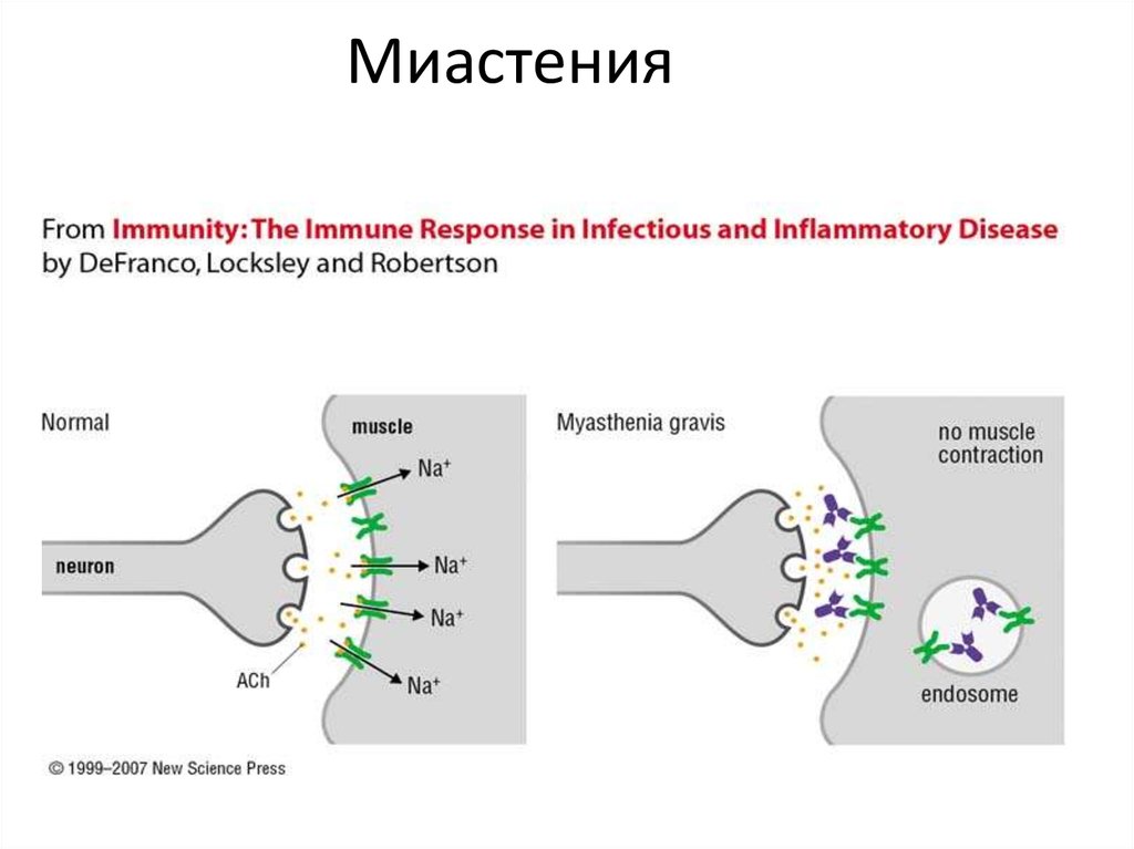 Миастения это простыми словами