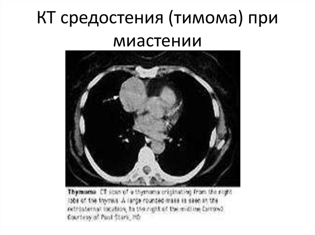 Тимома кт картина