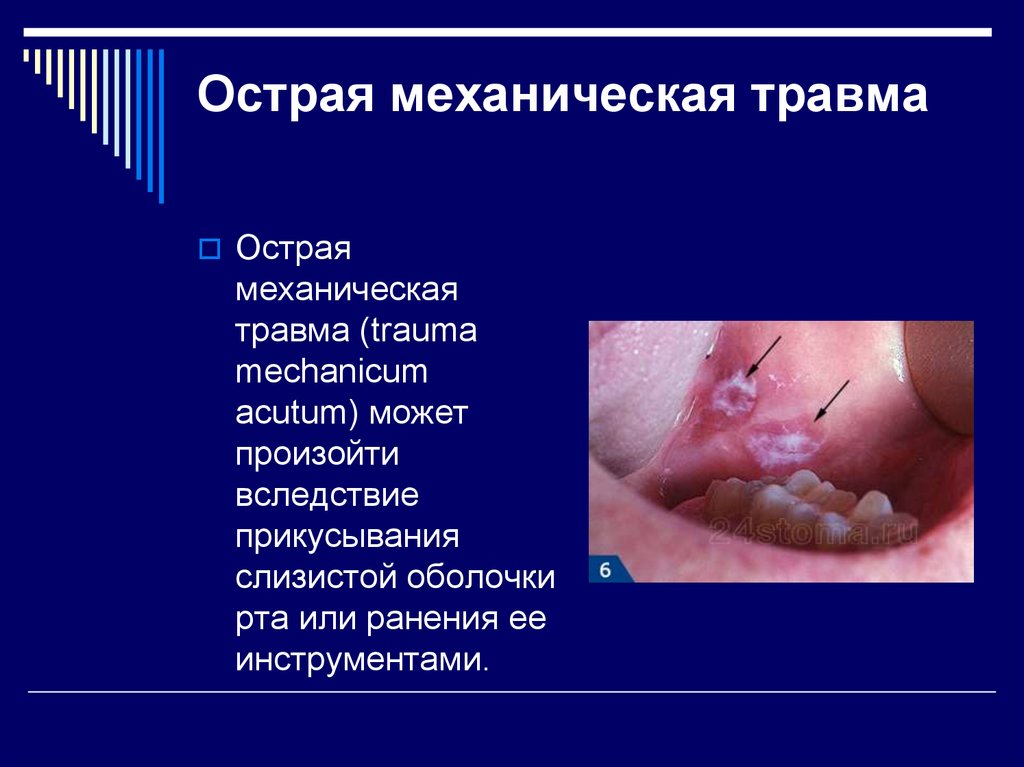 Кандидоз слизистой рта фото