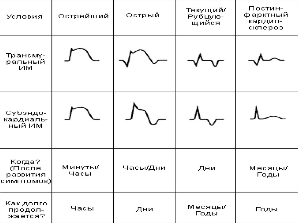 Диагноз миокарда. Стадии инфаркта миокарда на ЭКГ. Периоды течения инфаркта миокарда на ЭКГ. ЭКГ диагноз инфаркта миокарда. Инфаркт миокарда острый период ЭКГ.