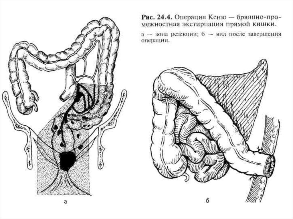 Операция толстой. Брюшно-промежностная экстирпация прямой кишки операция Кеню-Майлса. Экстирпация прямой кишки по Кеню Майлсу. Брюшно-промежностная экстирпация прямой кишки по Кеню Майлсу.