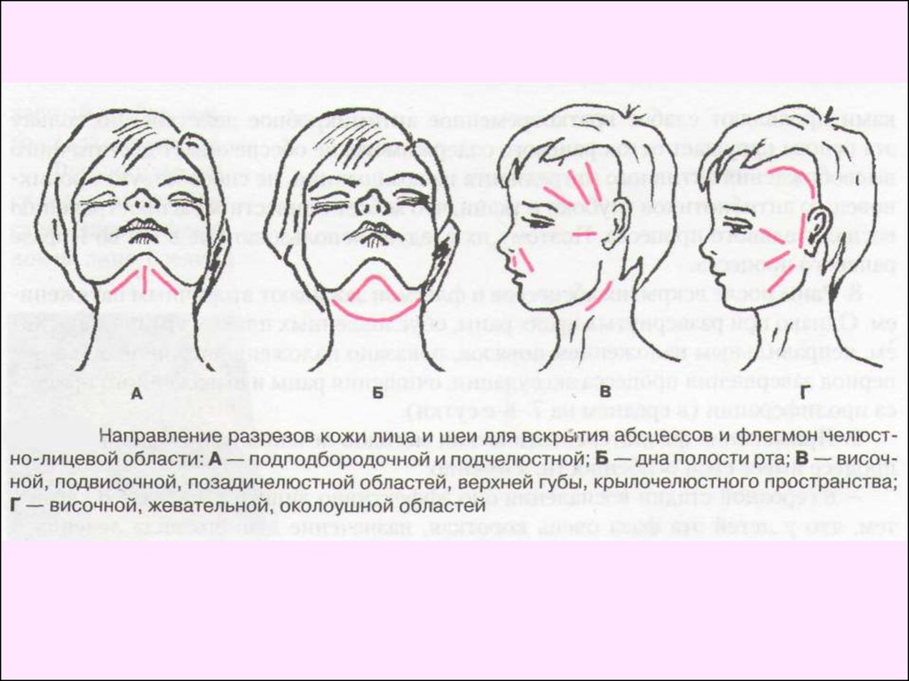 Вскрытие флегмоны шеи. Разрезы для вскрытия абсцессов шеи. Разрезы для вскрытия флегмон шеи. Разрезы при флегмонах лица.