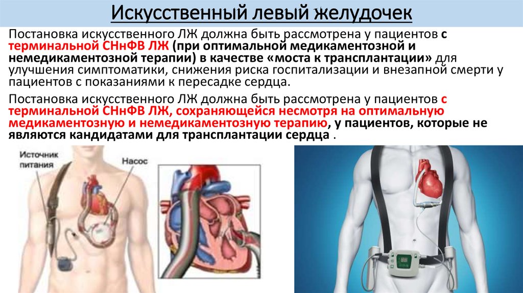 Терминальная сердечная недостаточность. Искусственный механический желудочек сердца. Искусственный левый желудочек. Искусственный левый желудочек сердца. Механический левый желудочек сердца.