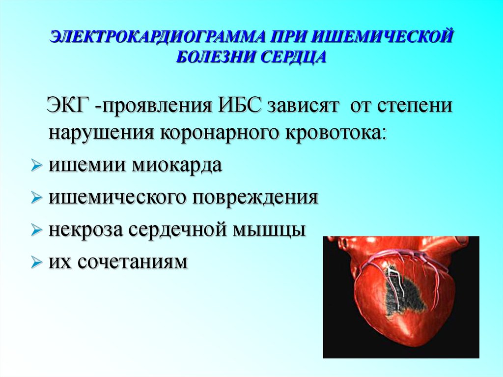 Ишемия отзывы. ЭКГ сердца при ишемии сердца. Ишемическая болезнь сердца (ИБС) ЭКГ.