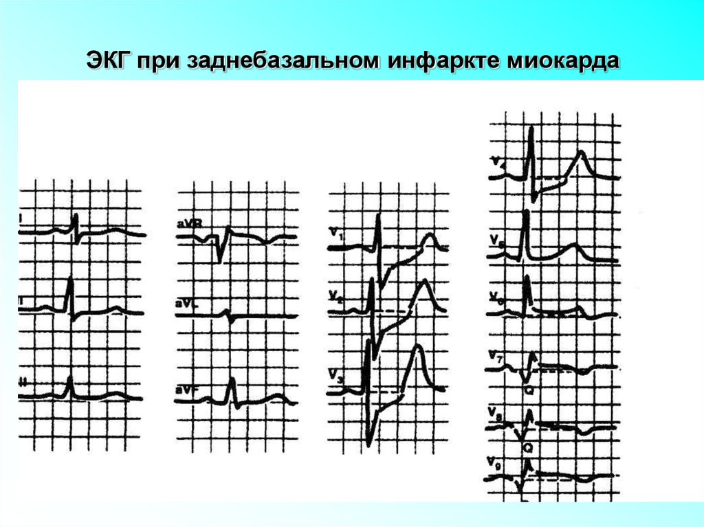 Экг при инфаркте миокарда. ЭКГ при заднебазальном инфаркте. Заднедиафрагмальный инфаркт на ЭКГ. Заднебазальный инфаркт ЭКГ. ЭКГ при стенокардии и инфаркте.