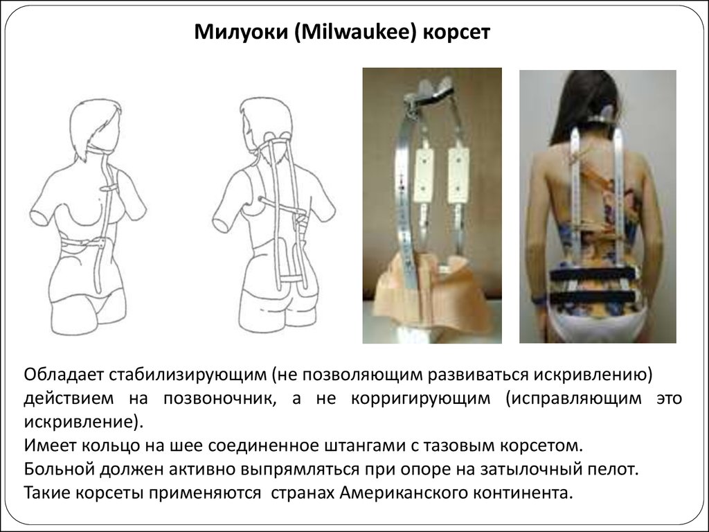 Миостимуляция при сколиозе схема