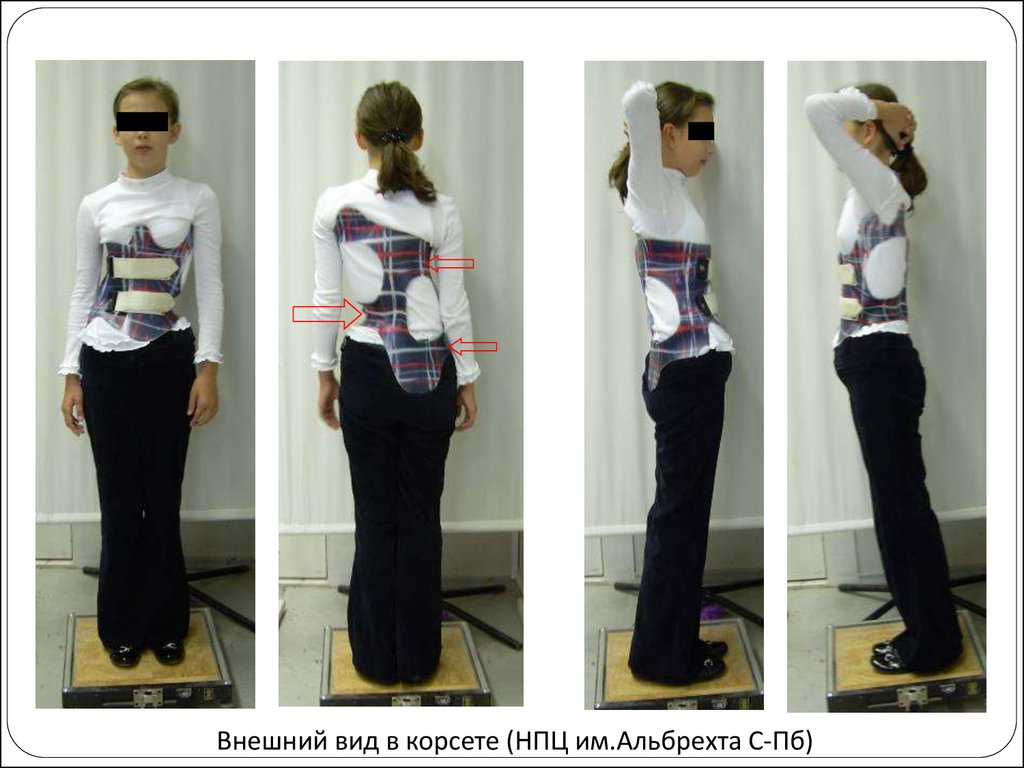 Корсет шена. Институт Альбрехта корсет Шено. Корсет Шено под одеждой. Корсет Шено в школе. Одежда подростку на корсет Шено.