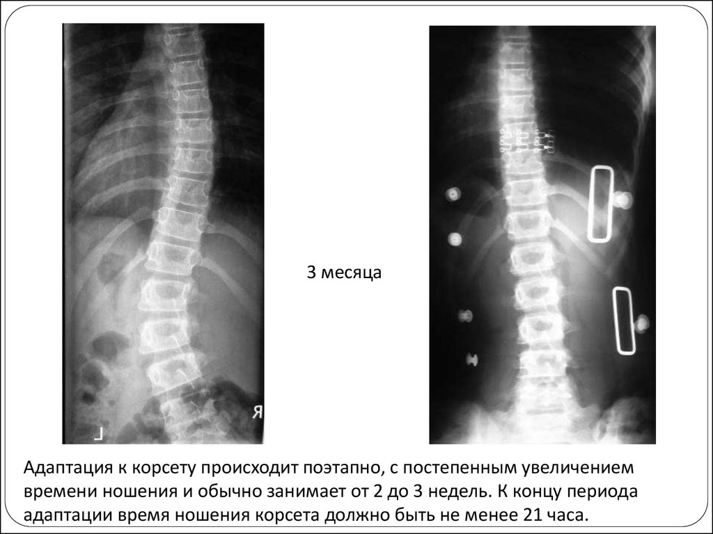 Сколиоз 3 степени фото рентген