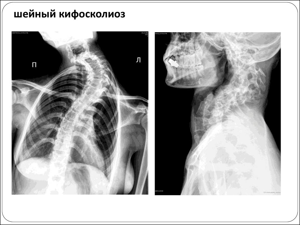 Кифосколиоз. Кифосколиоз шейного отдела. Кифосколиоз шейного отдела позвоночника. Кифосколиоз степени рентген. Кифосколиоз грудного отдела позвоночника рентген.