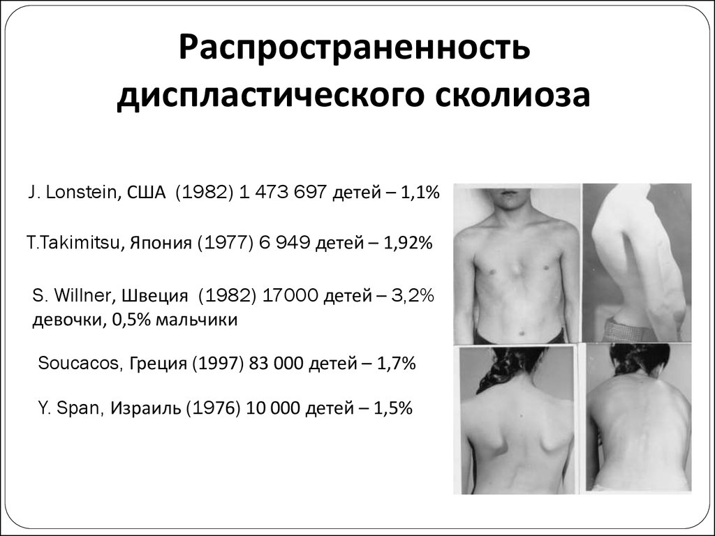 Идиопатический сколиоз 2 степени. Идиопатический сколиоз. Степени сколиоза. Юношеский идиопатический сколиоз 4 степени. Юношеский идиопатический сколиоз 2 степени.