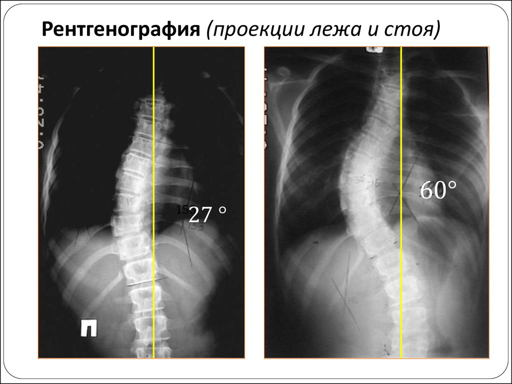 Снимки положений. Сколиоз грудного отдела рентген. Сколиоз грудного отдела позвоночника рентген. Рентген грудного отдела в боковой проекции.