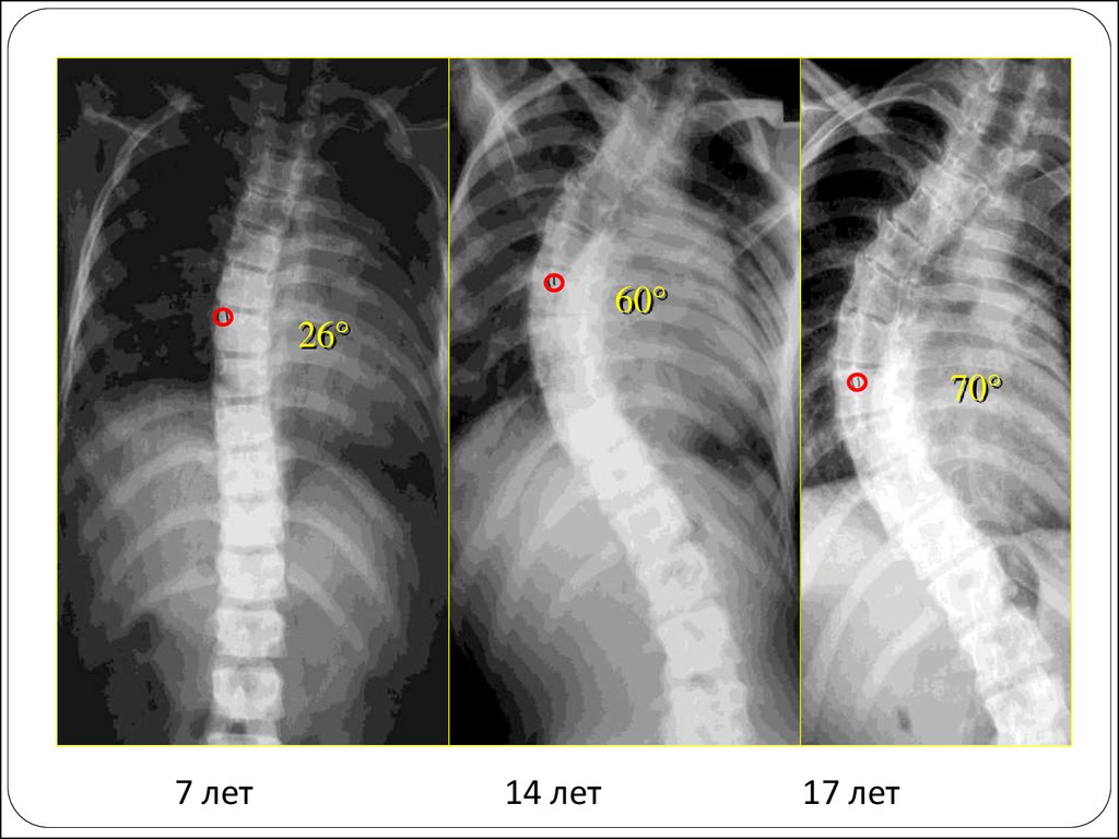 10 степень сколиоза. Сколиоз 2 степени рентген. Сколиоз 1 степени рентген. Сколиоз 4 степени рентген. Сколиоз торсия.