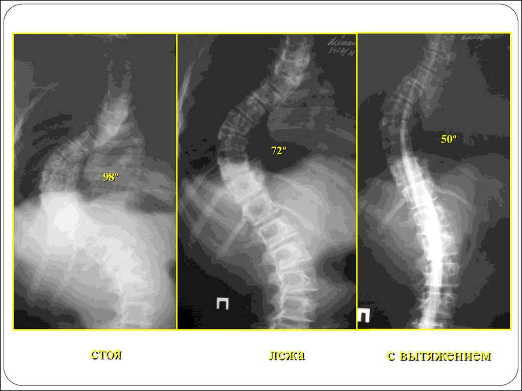 Рентген стоя. Z образный сколиоз рентген. Структурный и неструктурный сколиоз.