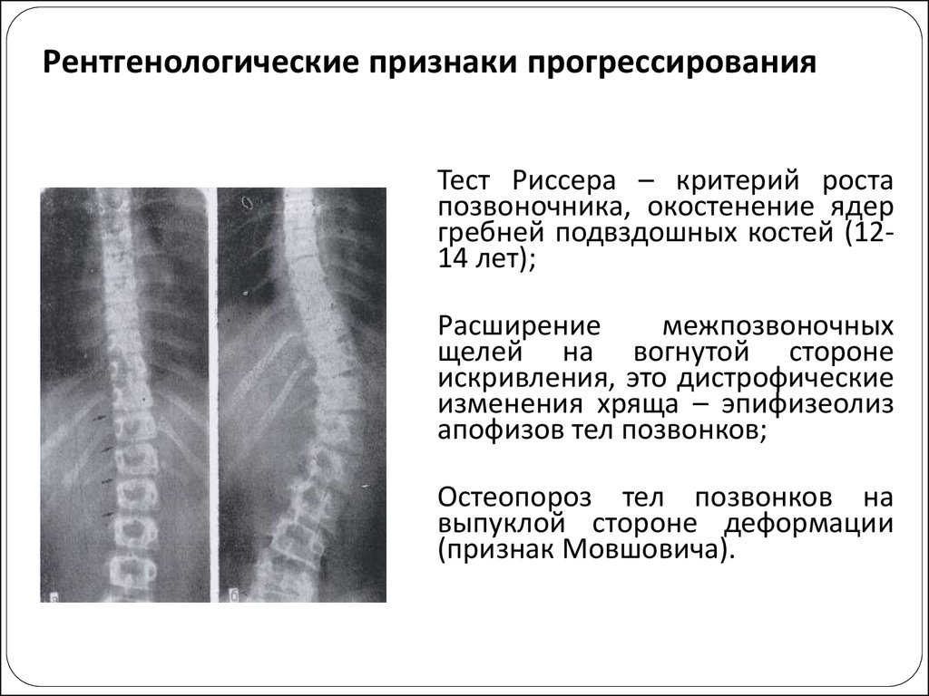 Сколиоз 1 степени. Тест риссера. Тест риссера при сколиозе как оценить. Тест риссера 3 что это.