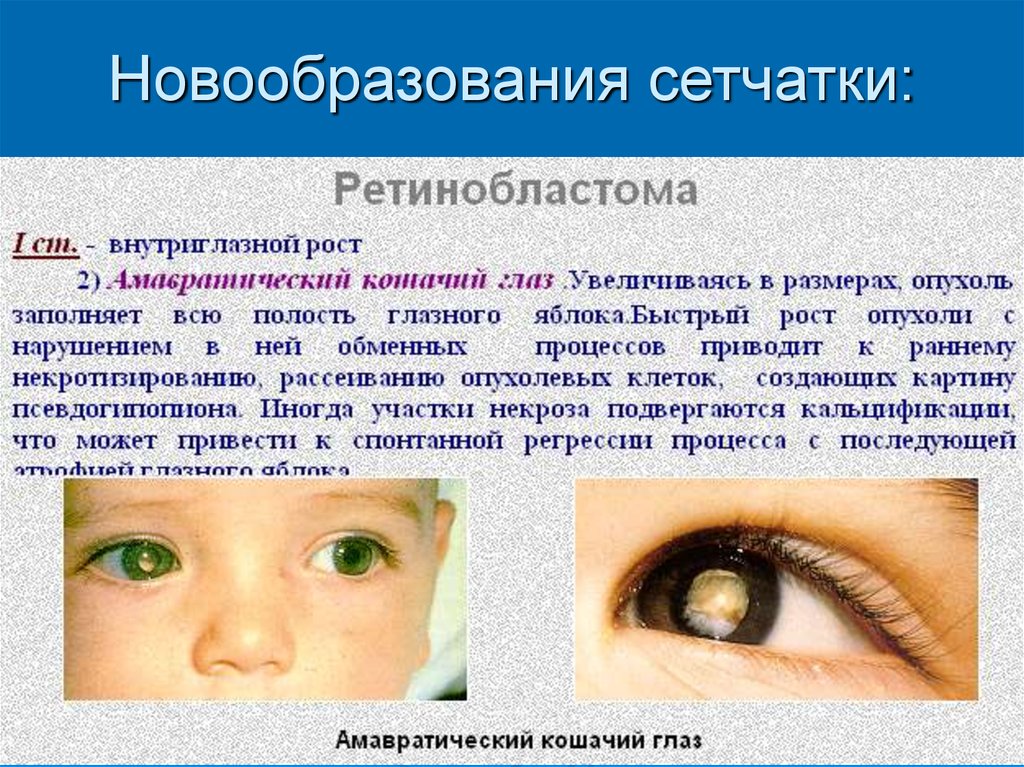 Глаза признак. Ретинобластома 4 стадия. Ретинобластома 3 стадия. Ретинобластома сетчатки. Ретинобластома у детей презентация.