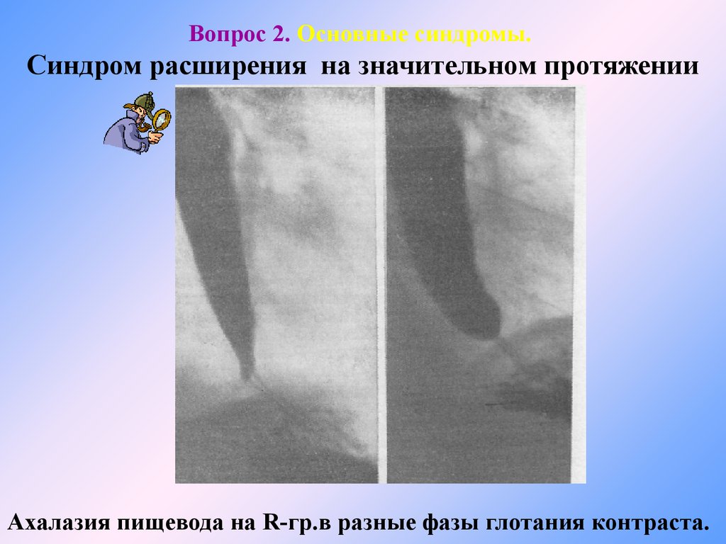 Ахалазия пищевода презентация