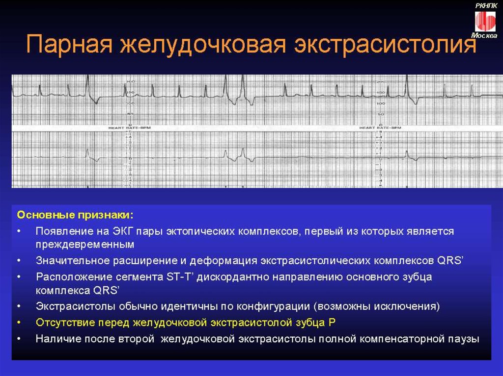 Одиночные мономорфные экстрасистолы