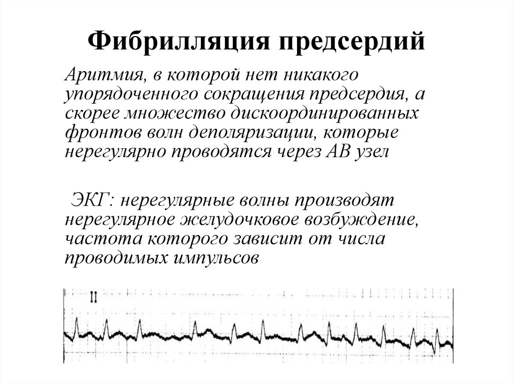 Купирования нарушение ритма. Фибрилляция предсердий на ЭКГ. Желудочковые нарушения ритма. ЭКГ нерегулярность ритма. Желудочковые нарушения ритма ЭКГ.