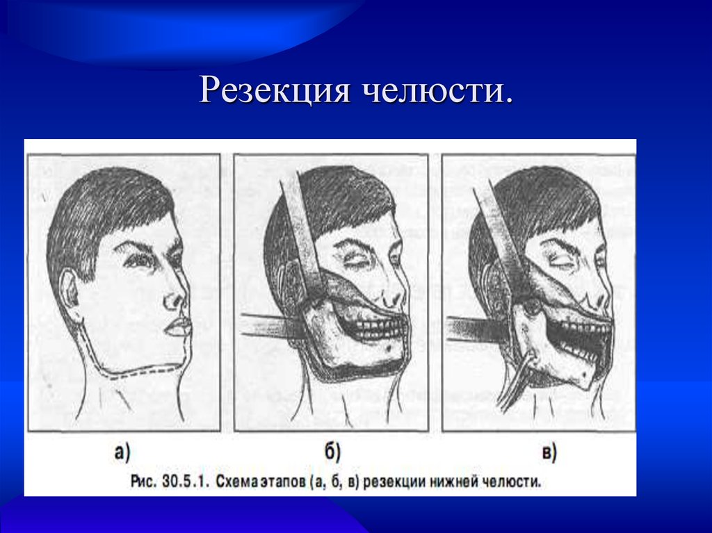 Резекция верхней челюсти презентация