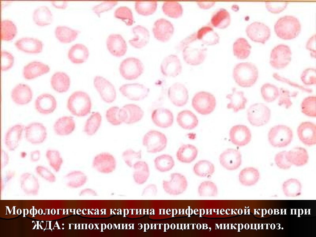 Гипохромия железодефицитная анемия. Гипохромия эритроцитов картина крови. Гипохромия микроцитоз. Железодефицитная анемия картина крови. Гипохромная анемия мазок крови.