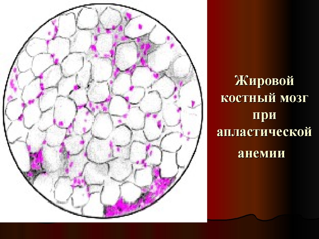 Апластическая анемия рисунок