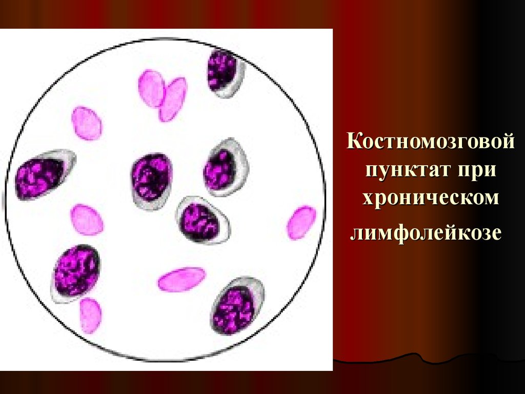 Созылмалы лимфолейкоз презентация