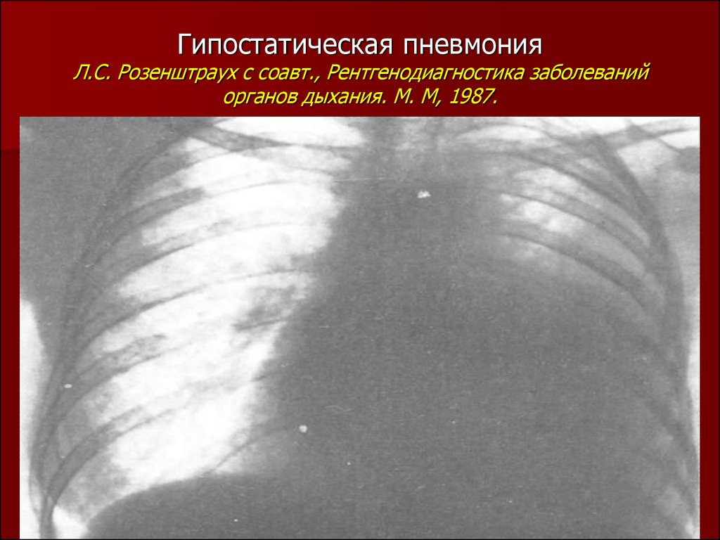 Застойная пневмония. Гипостатическая застойная пневмония. Застойная пневмония рентгенограмма. Застойная пневмония рентген. Пневмония гипостатическая j18 2.