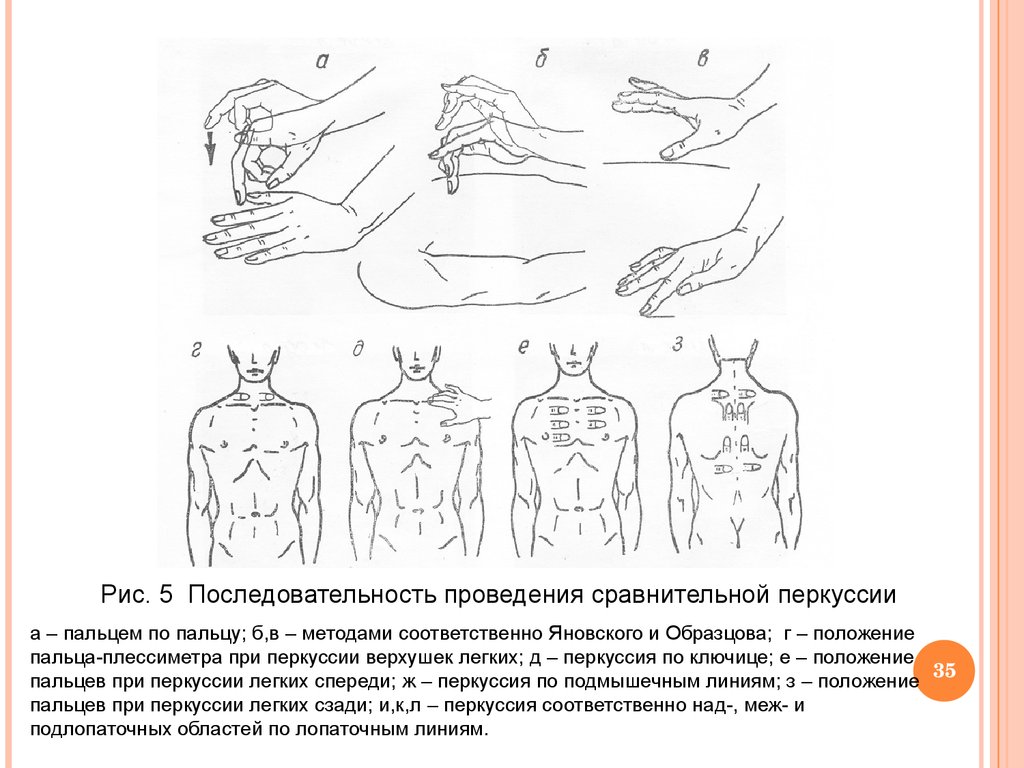 Перкуссия легких схема