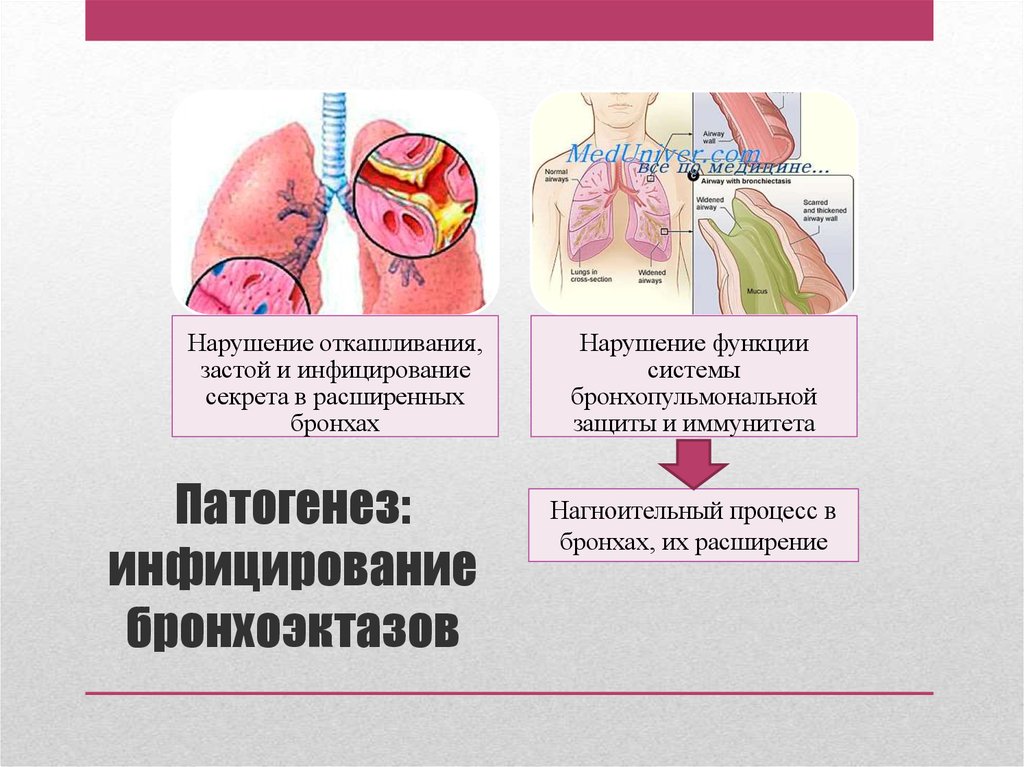 Расширение бронхов. Бронхоэктатическая болезнь этиология. Этиология бронхоэктатической болезни. Патогенез бронхоэктатической болезни. Бронхоэктатическая болезнь легких патогенез.