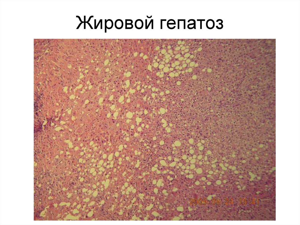 Жировая дистрофия презентация