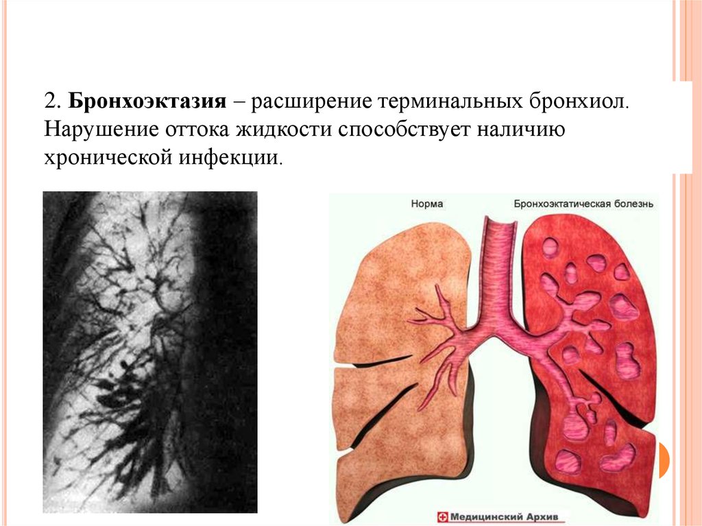 Нарушение оттока. Врожденные бронхоэктазы. Необратимое мешотчатое расширение терминальных отделов бронхиол. Бронхоэктазия цилиндрические.