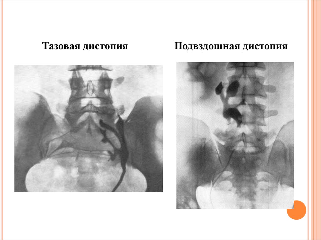 Нефроптоз дистопия. Дистопия почки рентген. Подвздошная дистопия почки. Поясничная дистопия почки.