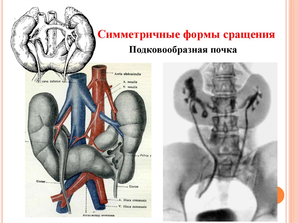 Аномалия развития почек презентация