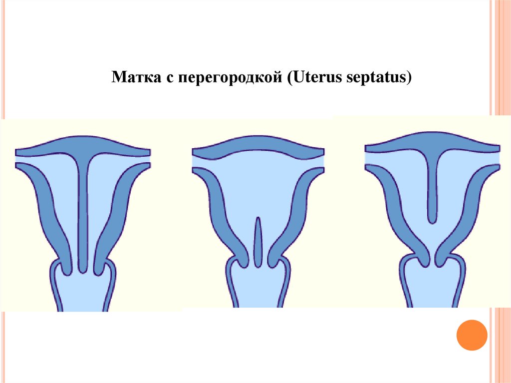 Перегородка в матке. Двурогая матка с перегородкой. Полная перегородка матки. Седловидная матка с перегородкой. Неполная перегородка матки.