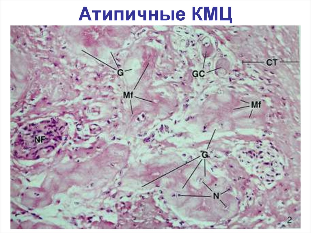 Атипичные кардиомиоциты рисунок