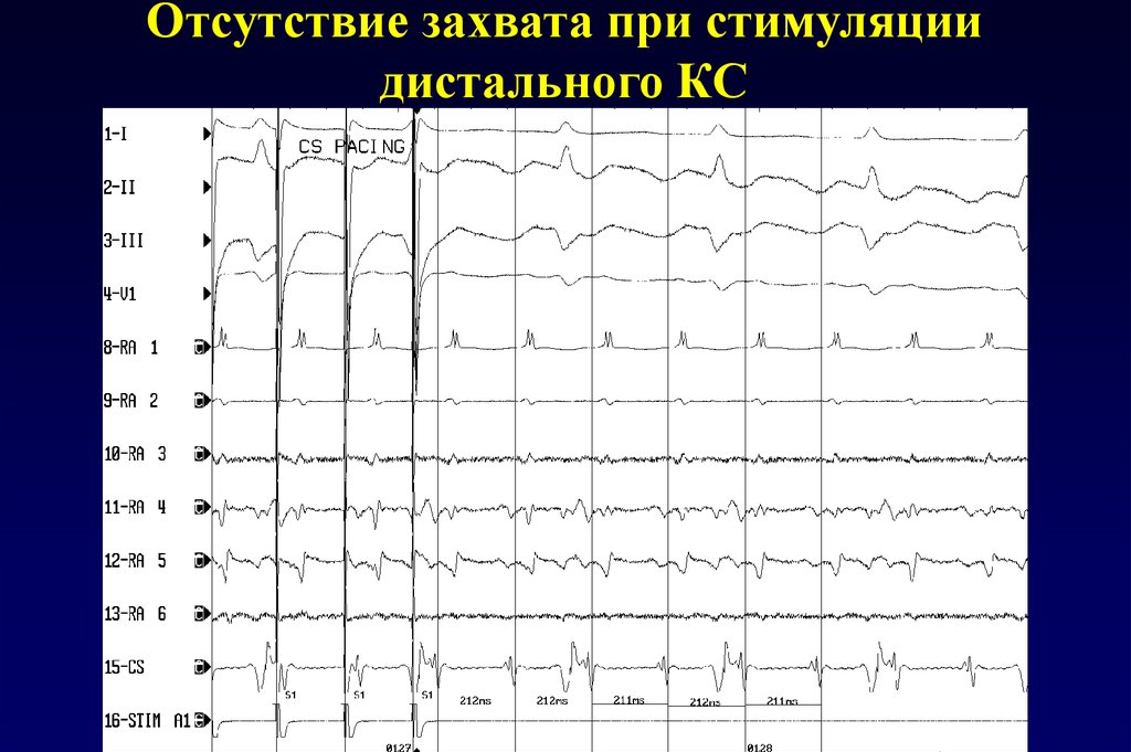 Сливной экс. Сливные и псевдосливные комплексы. Сливные комплексы на ЭКГ при экс. Псевдосливные комплексы на ЭКГ. Сливные и псевдосливные комплексы с экс.