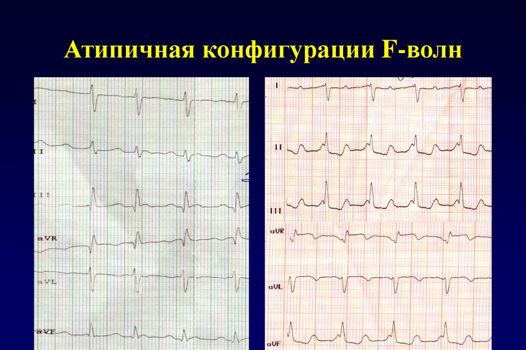 Волны при трепетании предсердий. Патологическая волна f. Волны f в грудных отведениях как выглядят.