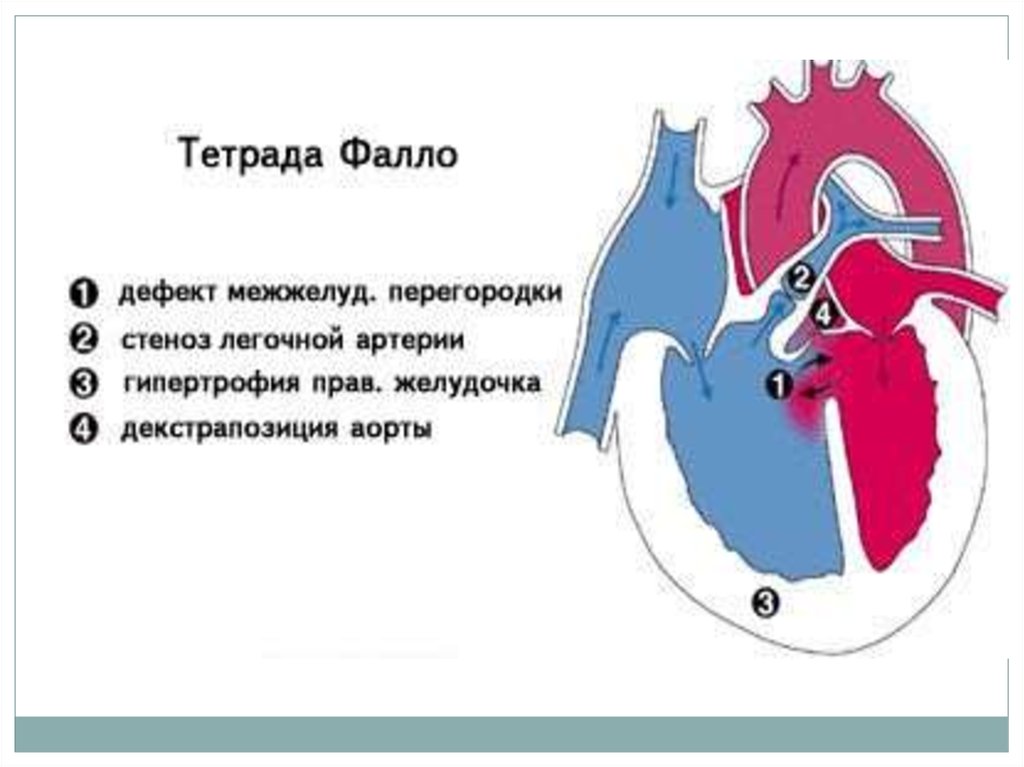 Тетрада фалло гемодинамика схема