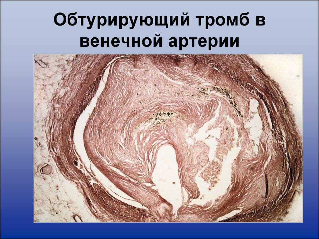 Тромб микропрепарат. Тромб артерии микропрепарат. Тромбоз коронарной артерии макропрепарат. Белый тромб в артерии микропрепарат. Обтурирующий тромб гистология.