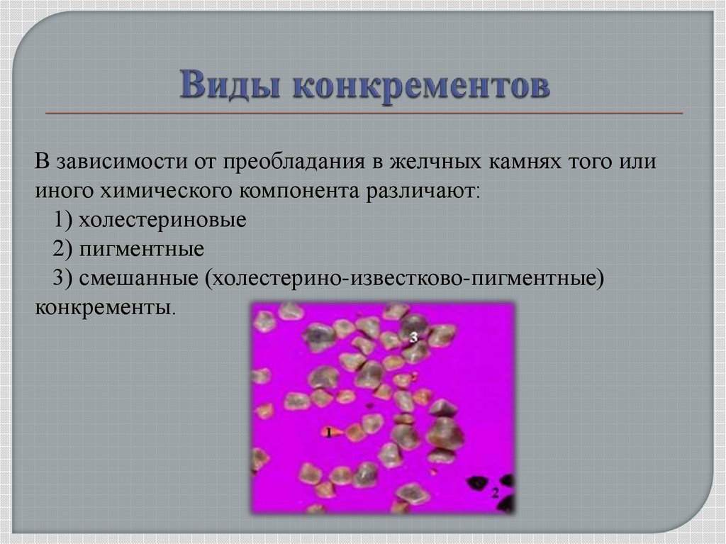 Виды конкрементов