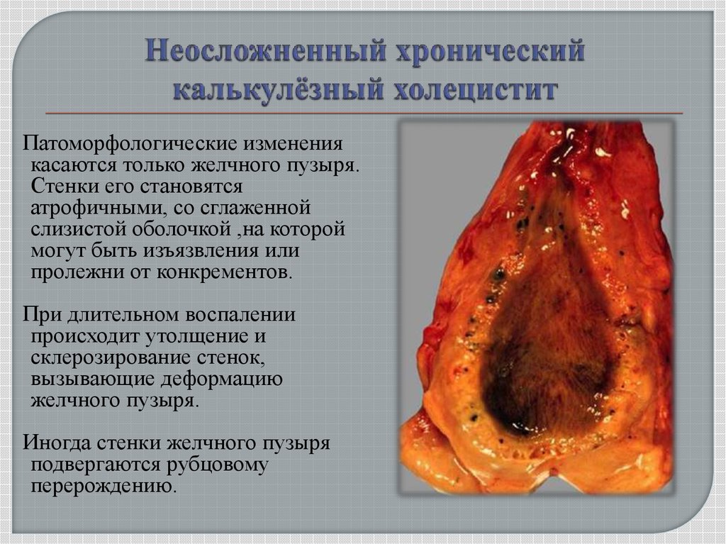 Стол при панкреатите и холецистите