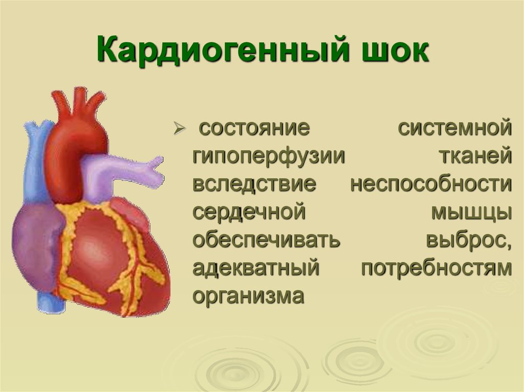 Кардиогенді шок презентация