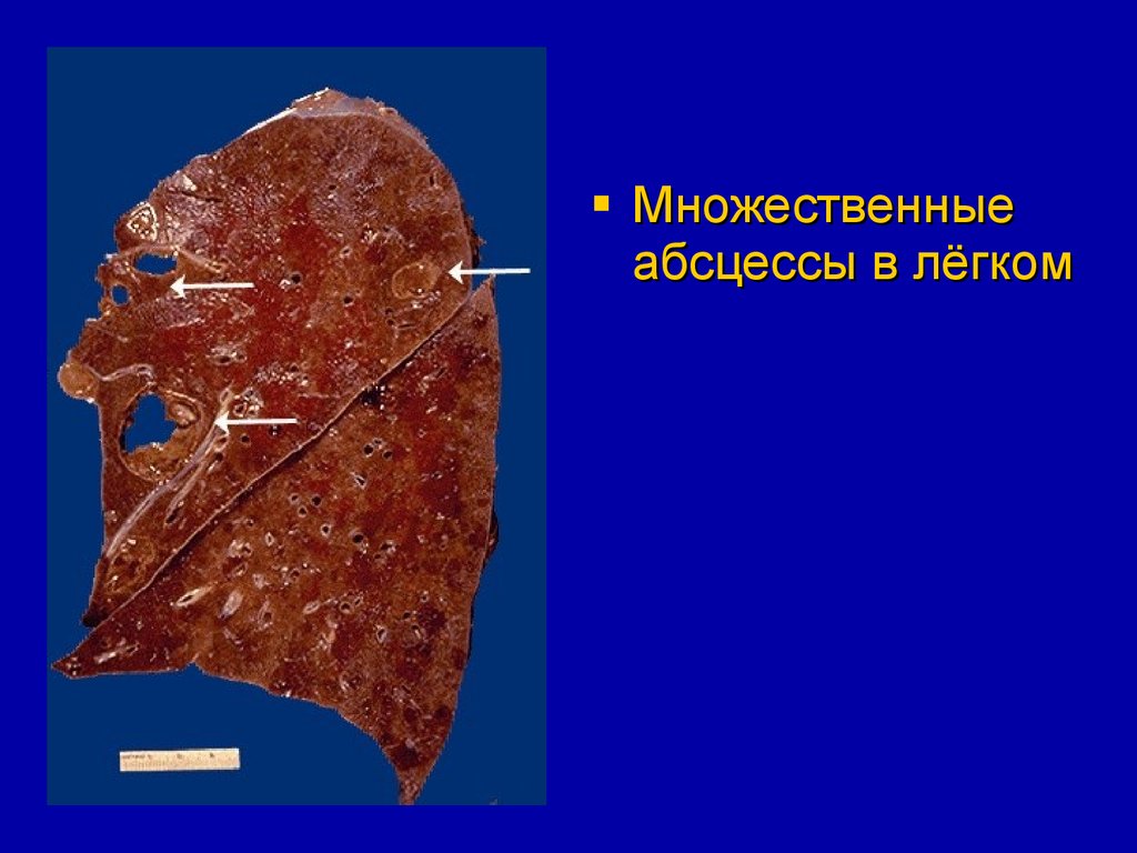 Сепсис легких. Острый абсцесс легкого макропрепарат. Абсцесс легких макропрепарат. Абсцесс лёгкого макропрепарат. Хронический абсцесс легкого макропрепарат.