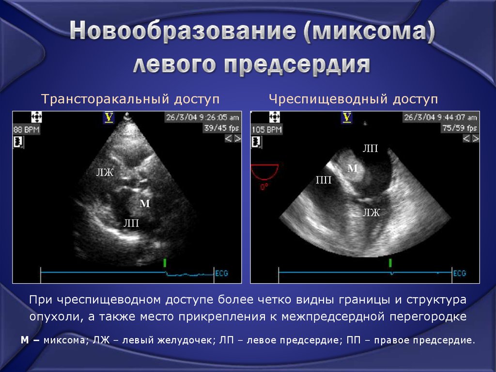 Тромбоз ушка предсердия. Дефект межпредсердной перегородки ЭХОКГ. Аневризма межжелудочковой перегородки ЭХОКГ. Новообразования сердца.