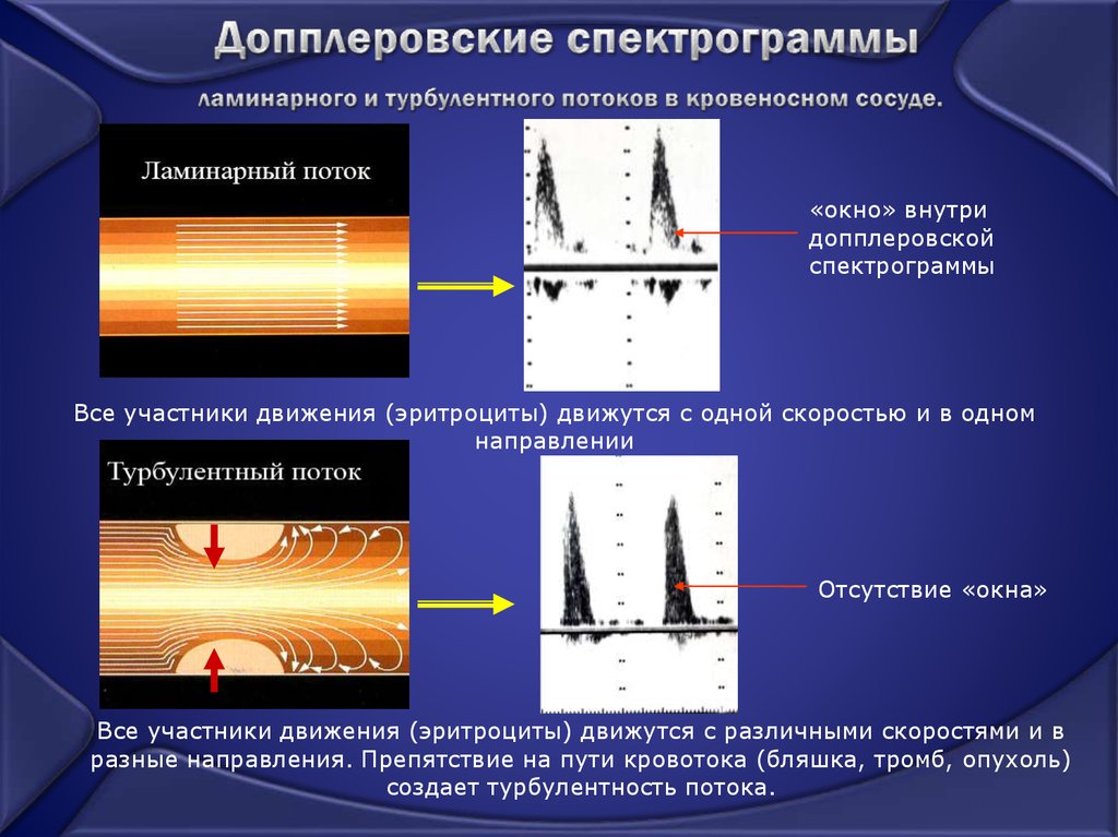 Допплеровские спектрограммы ламинарного и турбулентного потоков в кровеносном сосуде.
