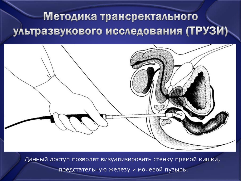 Трузи предстательной железы мочевого пузыря. Ультразвуковое исследование прямой кишки трансректальное. Трансректальное УЗИ предстательной железы. Ректальное исследование железы (трузи). УЗИ простаты трансректальным датчиком.