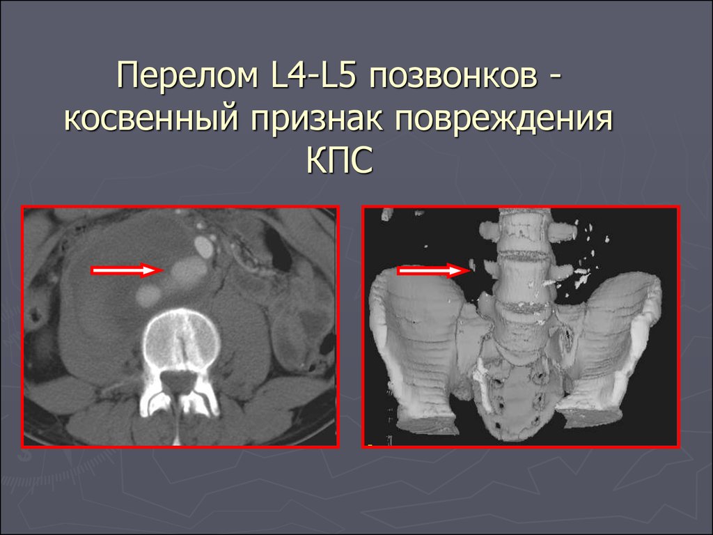 Перелом позвоночника симптомы. Перелом позвоночника l4 l5. Линейный перелом позвонка.