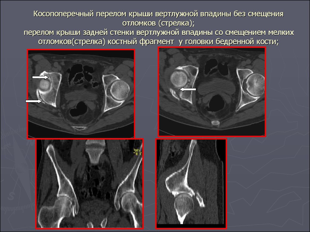 Перелом вертлужной впадины презентация