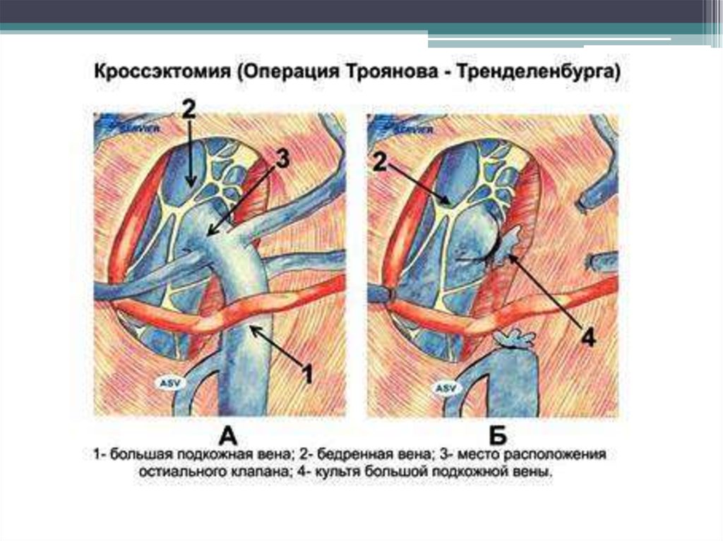 Перевязка подкожных вен. Операция Троянова-Тренделенбурга. Операция Троянова-Тренделенбурга техника. Бедренная Вена кроссэктомия. Кроссэктомия операция Троянова Тренделенбурга.