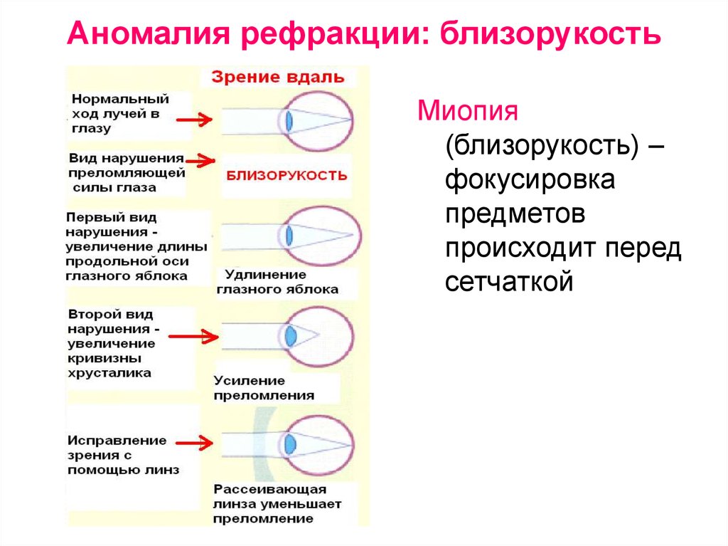 Какие новые точки зрения. Аномалии рефракции глаза физиология. Аномалии рефракции глаза (близорукость, дальнозоркость, астигматизм). Аномалии рефракции глаза близорукость дальнозоркость. Нарушение рефракции и аккомодации глаза.